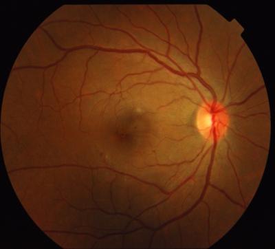 Figure 1: Fundus photograph showing bilateral macula oedema with yellow subretinal deposits and dot haemorrhages